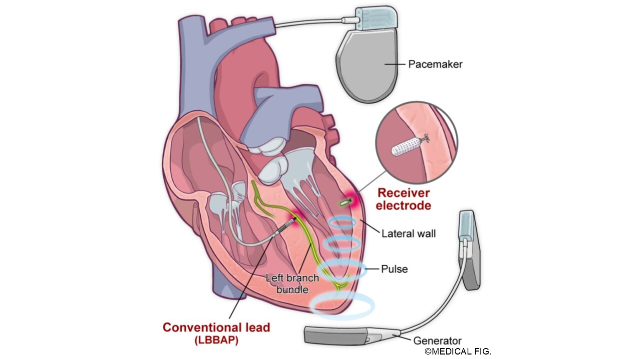 LOT-endo CRT