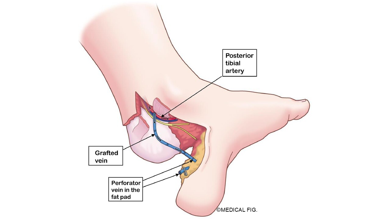 Heel pad injury, blood flow restoration