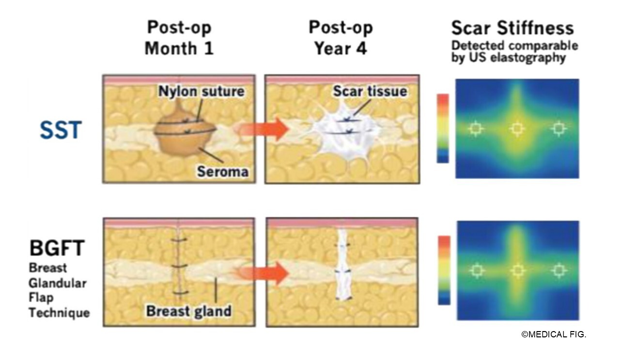 heal-ing processes between the SST and BGFT