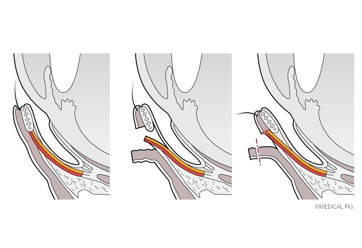 Schematic representation of lower eyelid cross section for the surgical technique
