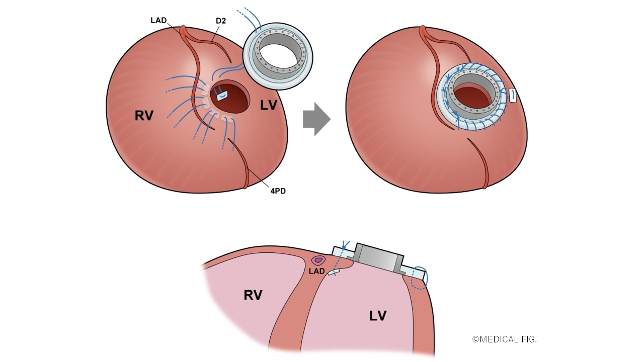 ミニカフ逢着図