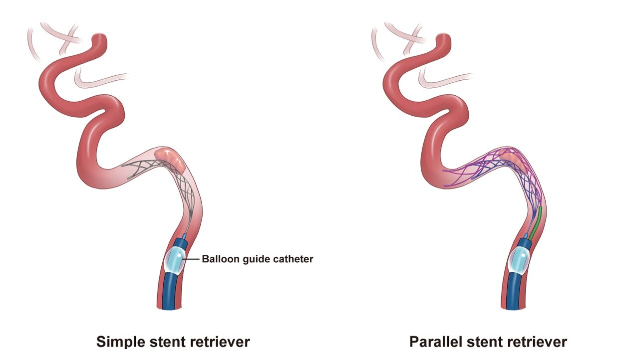 Parallel stent retriever technique