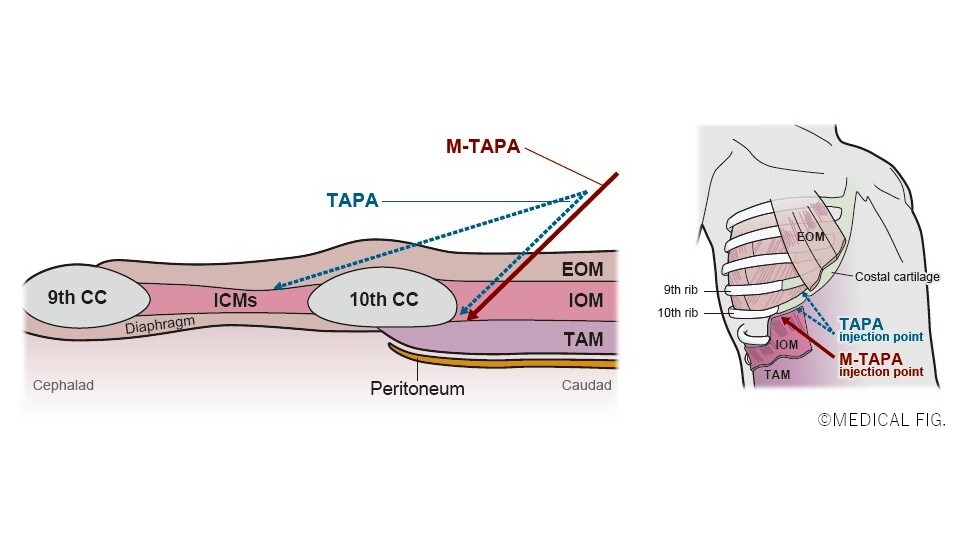 Schematic diagrams of the puncture sites and dissection for TAPA and M-TAPA.