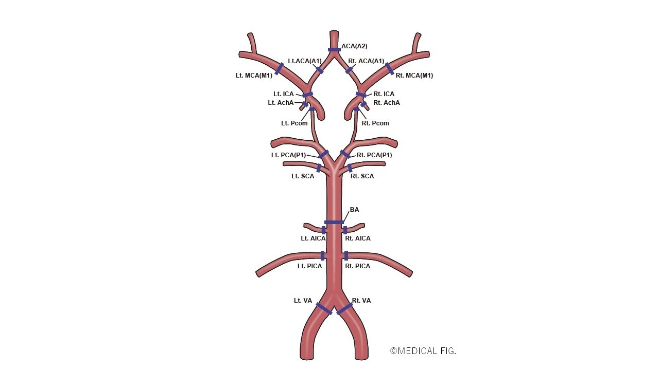 Measured sites of cerebral artery diameter